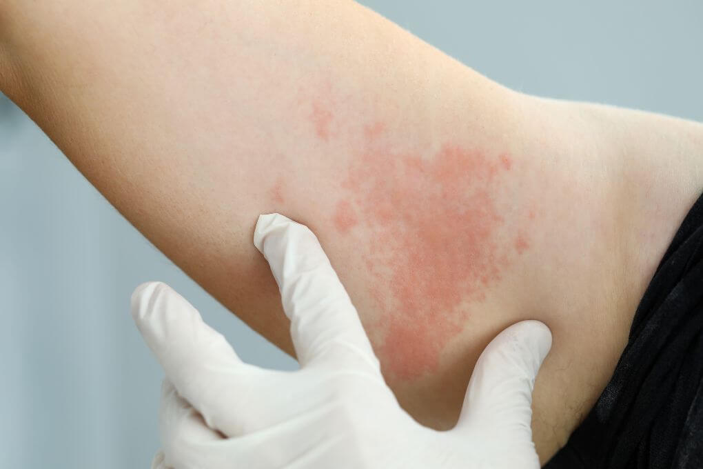 Histaminunverträglichkeit