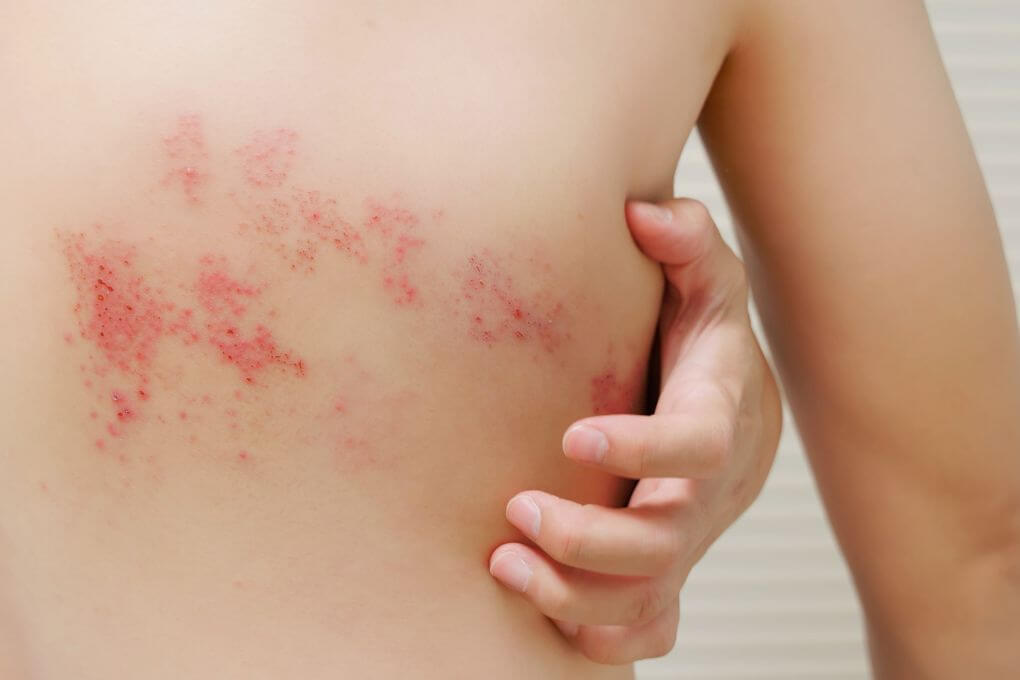 Herpes zoster